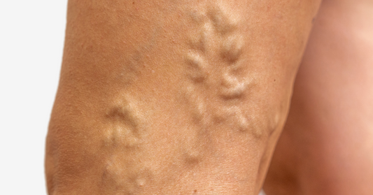 What is venous thrombosis? Better known as deep vein thrombosis?