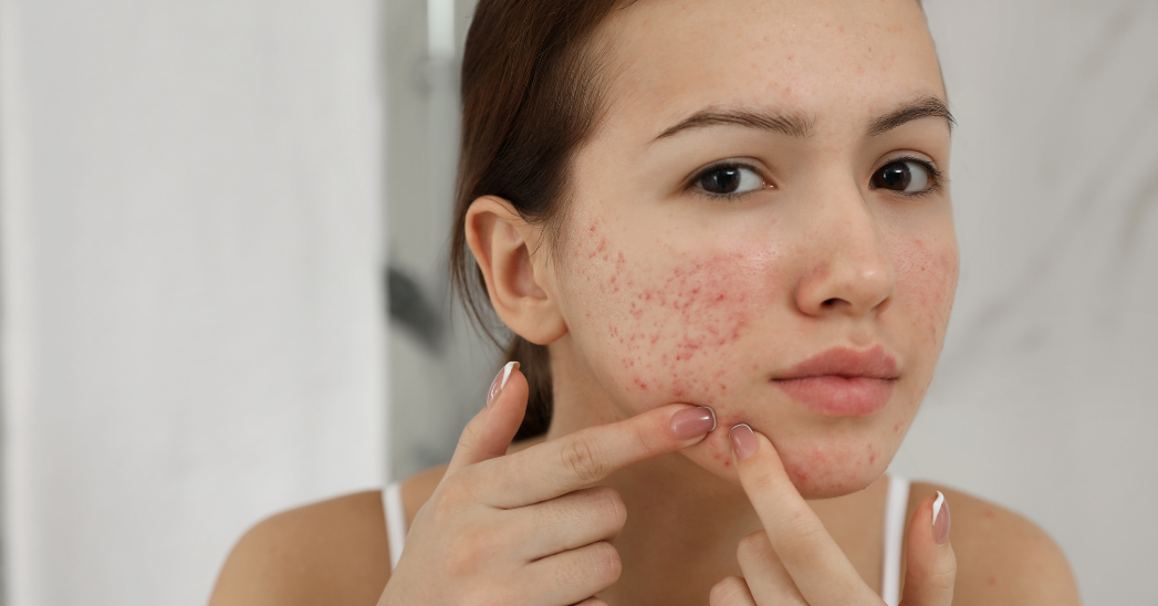 Acne symptoms