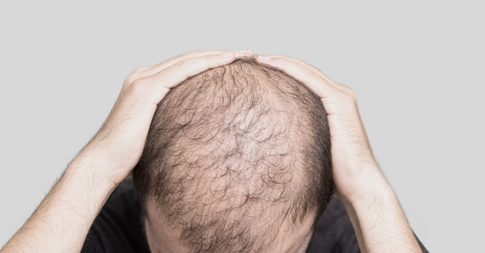 Baldness