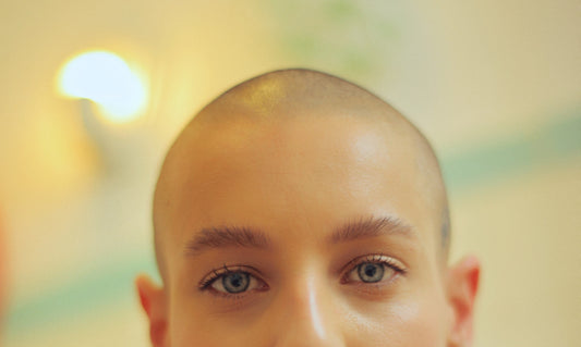 Alopecia areata