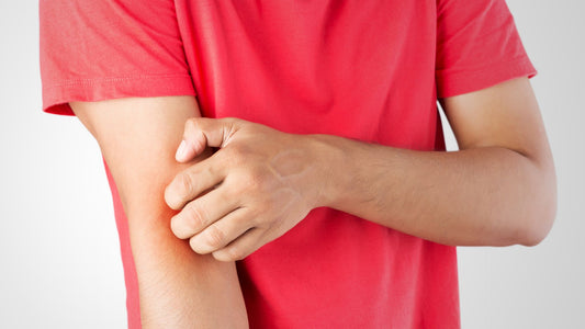 Eczema