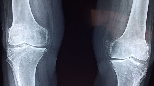 Can you prevent osteoarthritis in your knees and hips?