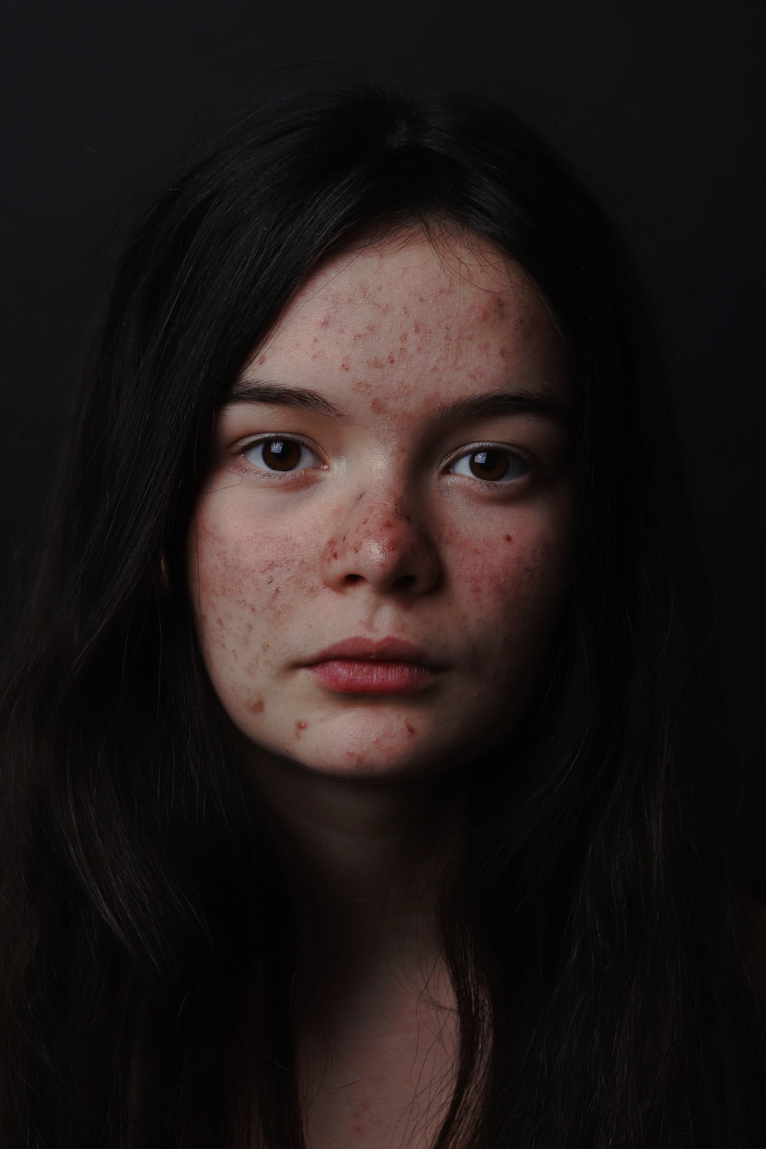 A girl with acnes