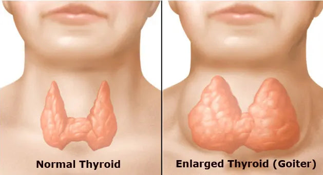 Nontoxic Multinodular Goiter