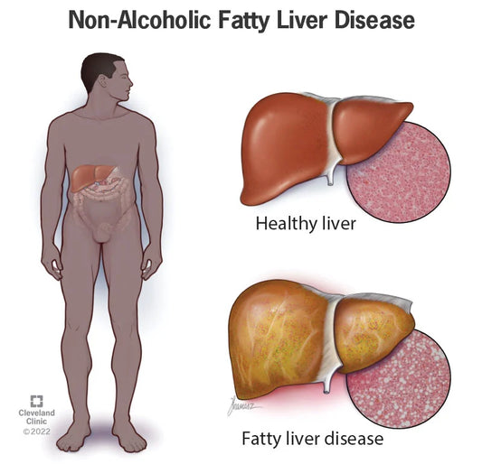 Nonalcoholic Fatty Liver Disease: A Silent but Serious Condition