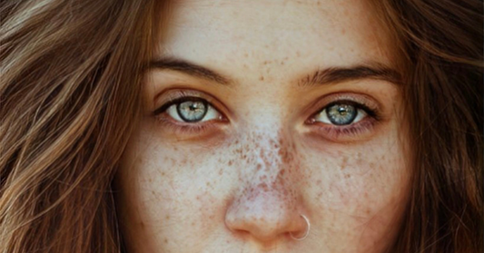 Freckles