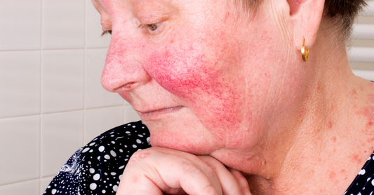 Rosacea