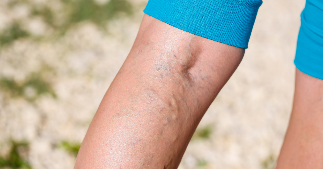 Varicose veins