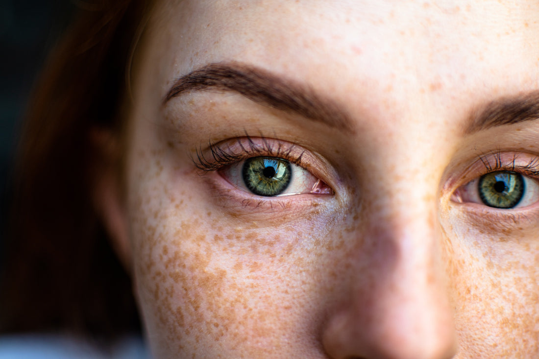 freckles