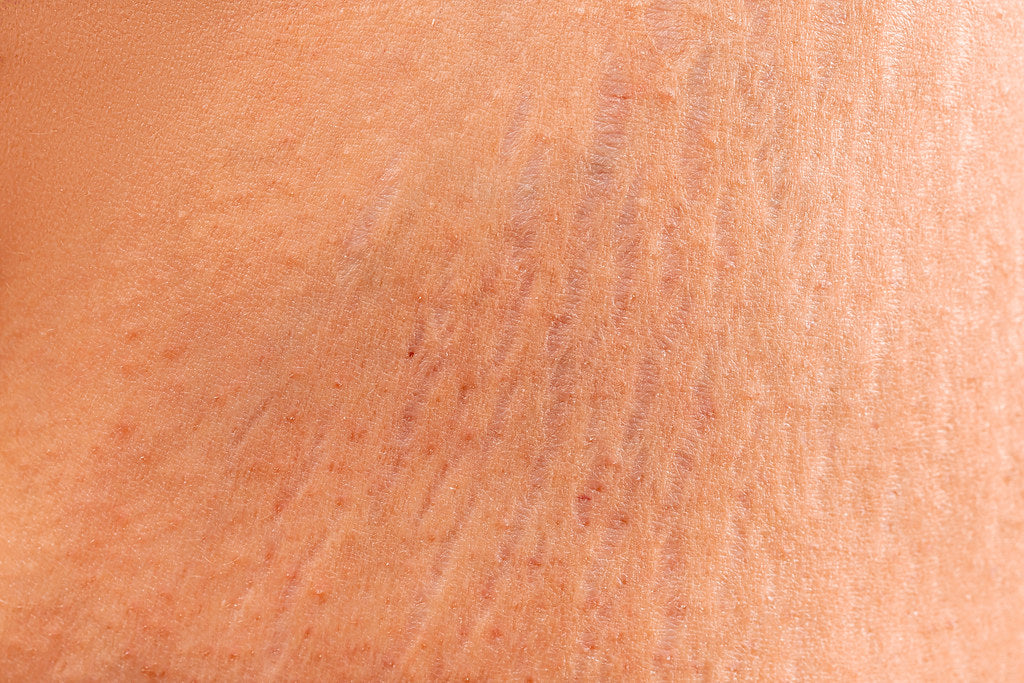 stretch marks because of DNA?